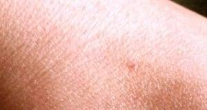 Pitiriasi rosea di Gibert dobbiamo preoccuparci