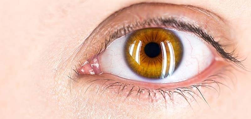 Cataratta una delle affezioni piu comuni de occhio