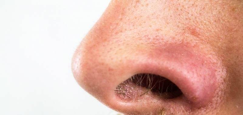 Punti neri Ecco come liberarsene