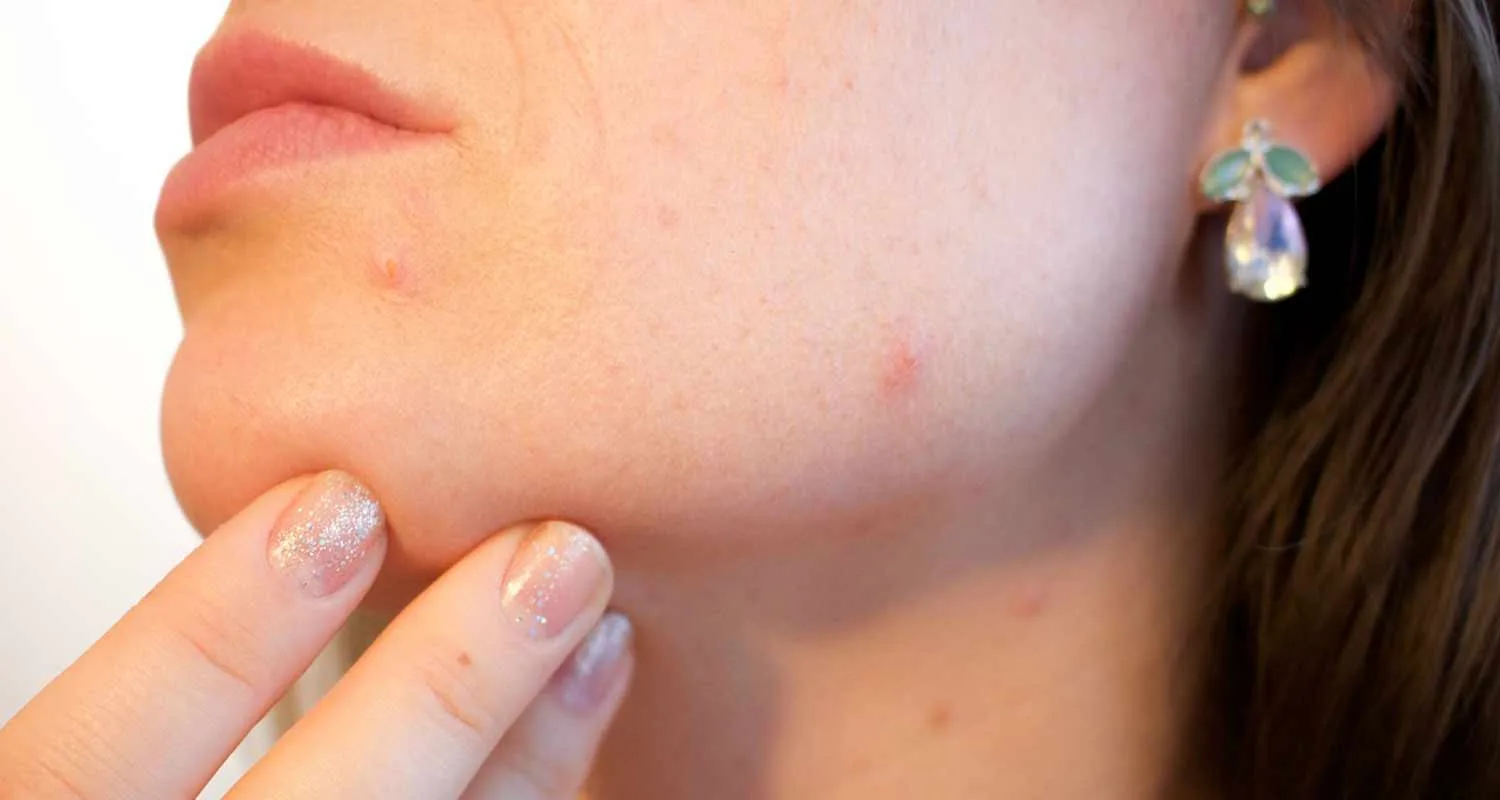 Consigli utili per combattere i brufoli