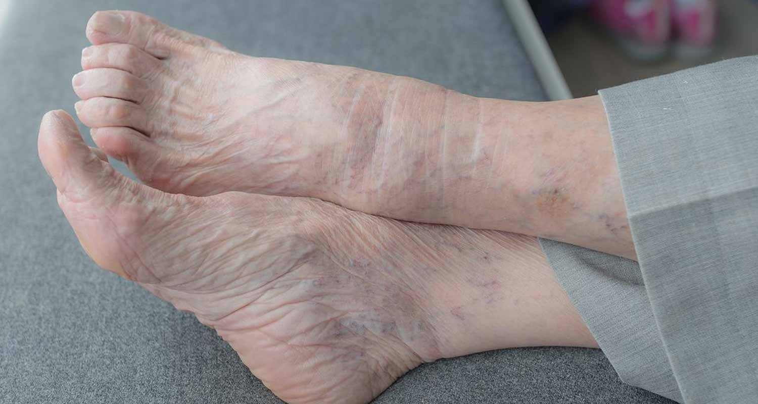 Perche il diabete ad un certo punto colpisce i piedi