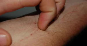 Scabbia sintomi e metodi di trattamento