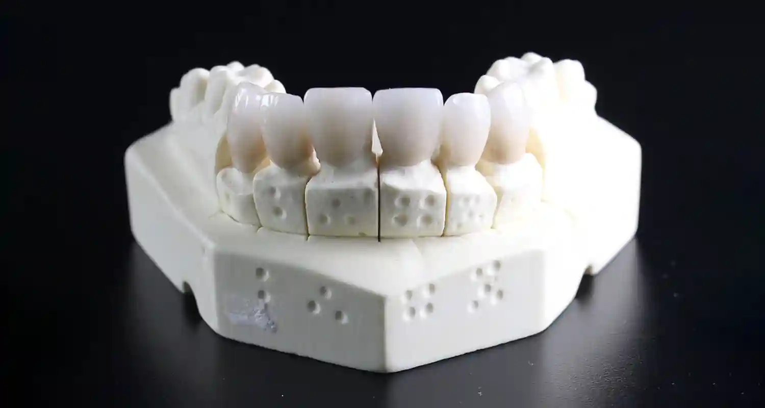 Paradontite e faccette dentali di cosa parliamo